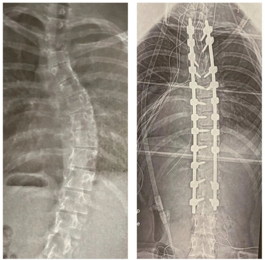 Before and after X-ray imagery of Zach Powers' surgically-improved spine.